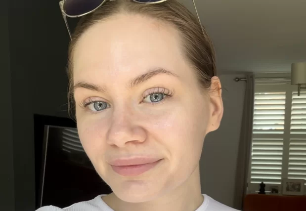 After a carbon laser peel