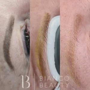 cosmetic tattoo removal preparation