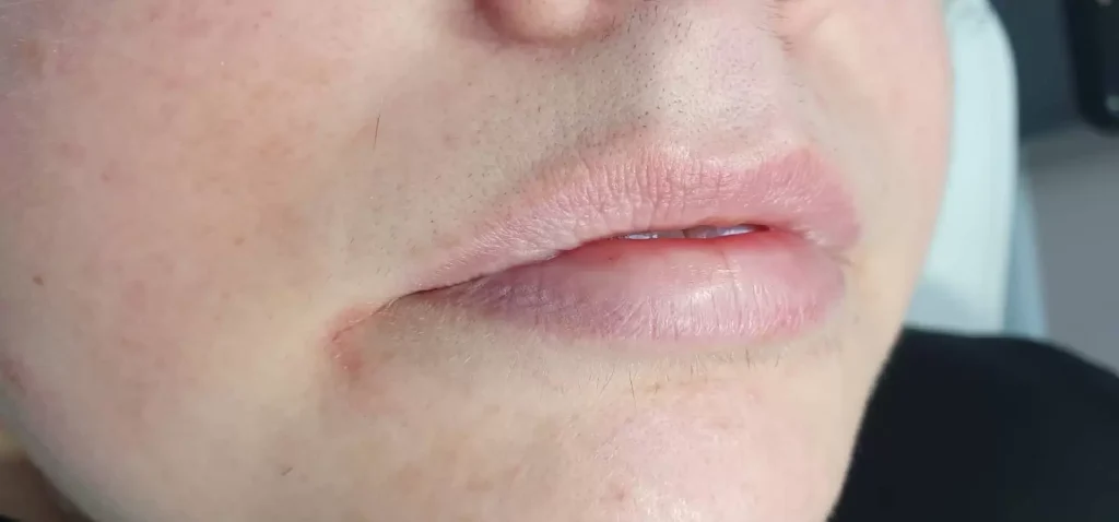 Sophie Freeman laser hair removal