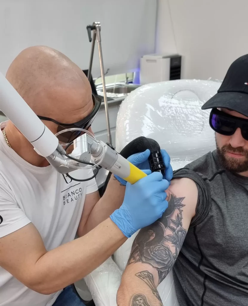 Tattoo Removal Cost in London