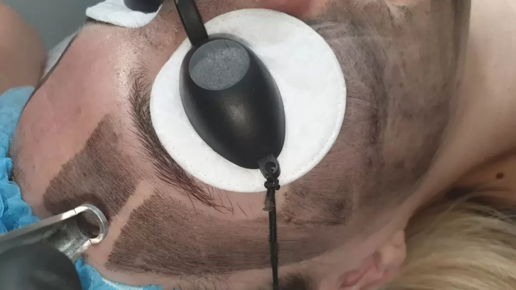 Emily’s Laser Carbon Peel