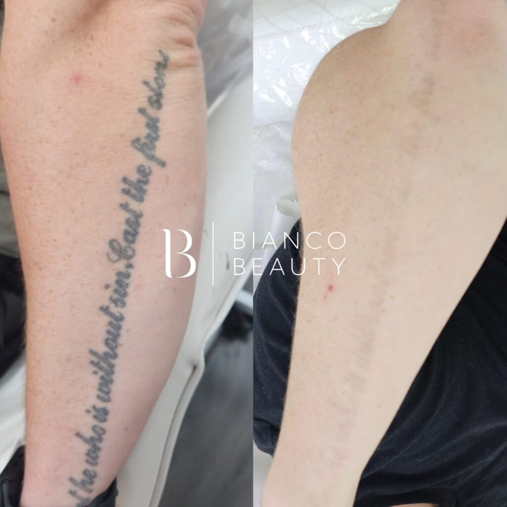 tattoo removal pain