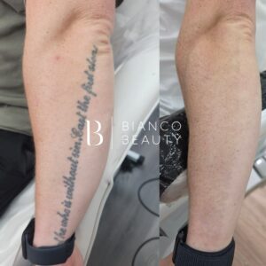 Questions Before Laser Tattoo Removal