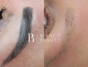 Eyebrow Tattoo Removal Leave Scars