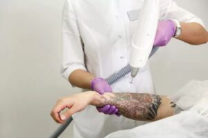 Getting a tattoo vs Laser Tattoo Removal
