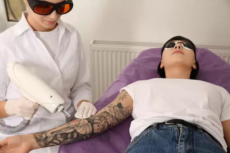cheap tattoo removal