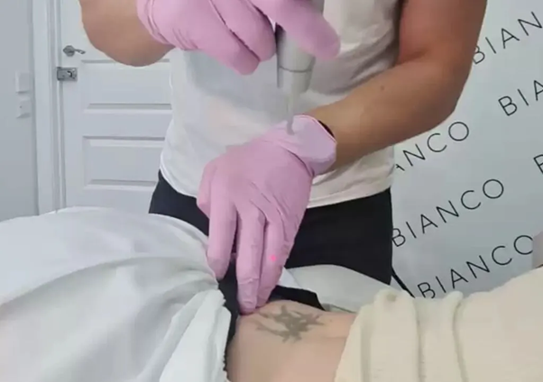 Incomplete Tattoo Removal