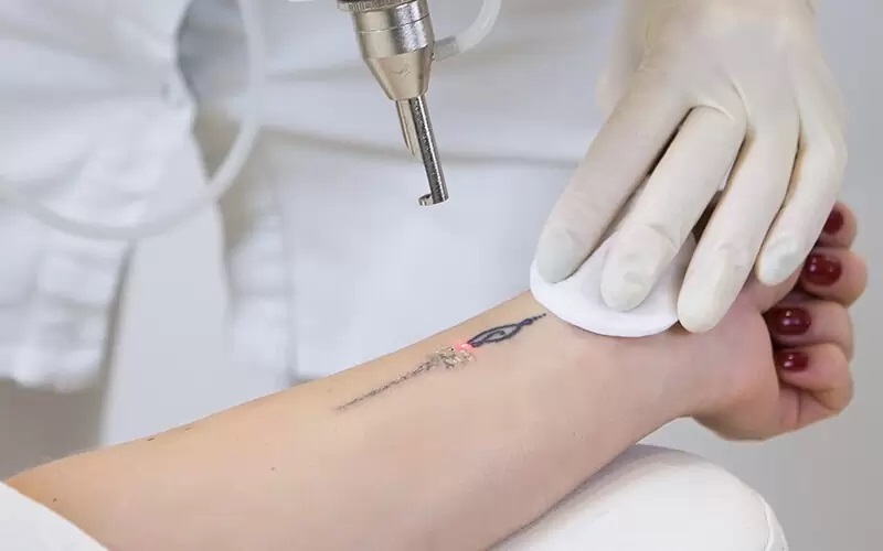 Advanced Laser Tattoo Removal Technology
