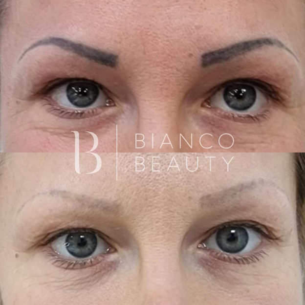 Eyebrow Tattoo Removal Healing Process