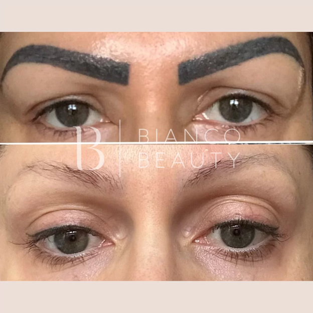 Preparing for Laser Eyebrow Tattoo Removal