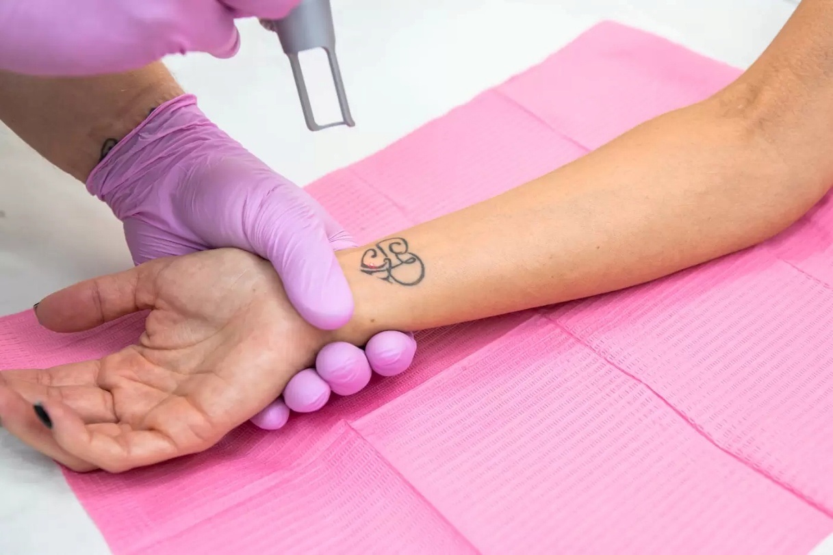 tattoo remains after removal