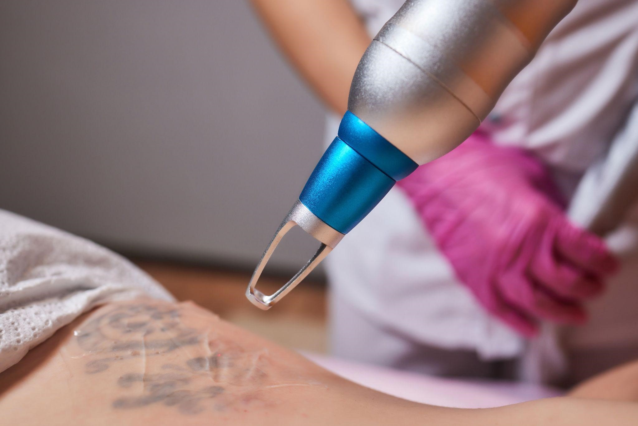 Consultation and picosecond laser tattoo removal treatment process in Manchester