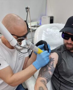 Get Your Tattoo Removed in the UK
