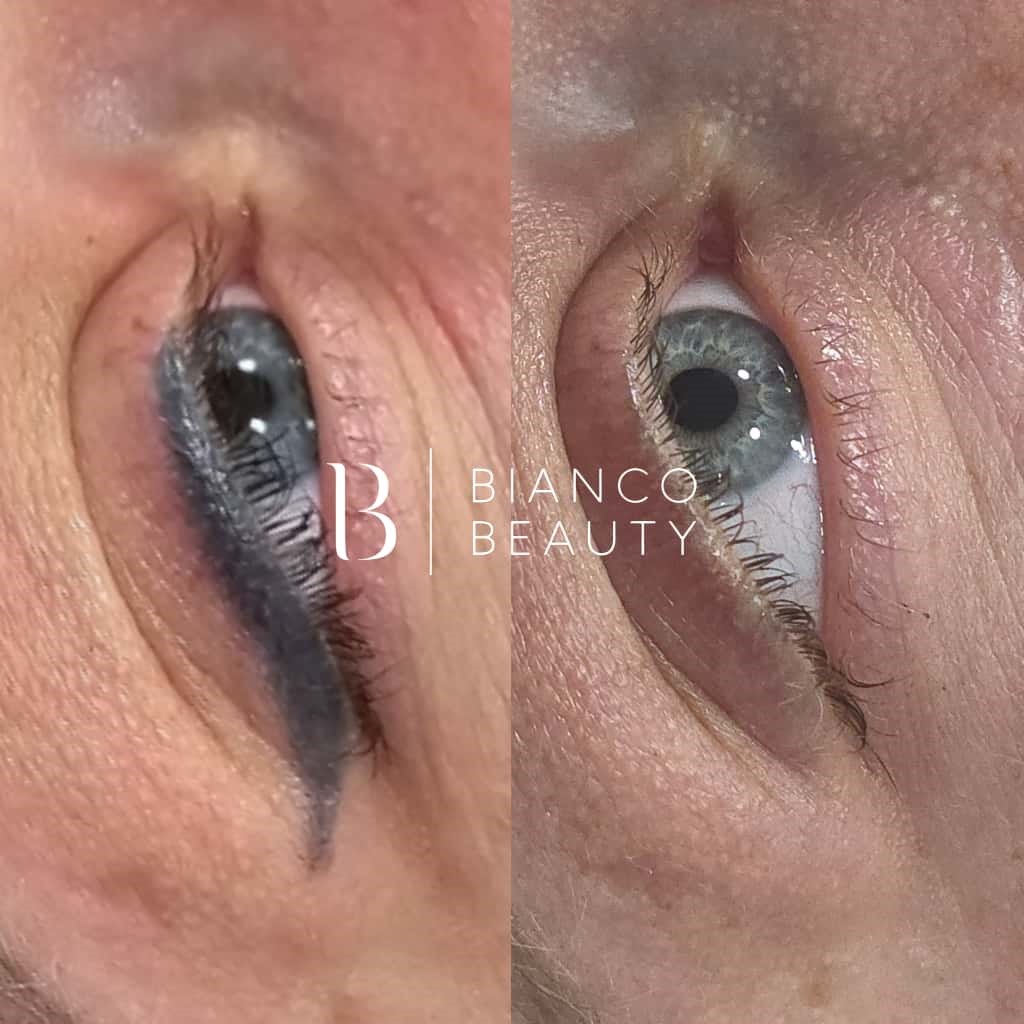 Picosecond laser removal for eyebrow, lip blush, and eyeliner tattoos
