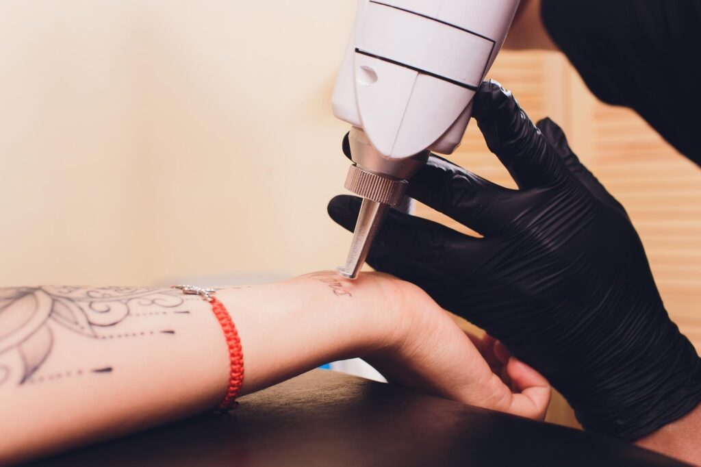 Picosecond laser tattoo removal Manchester treatment removing unwanted tattoo ink with advanced laser technology
