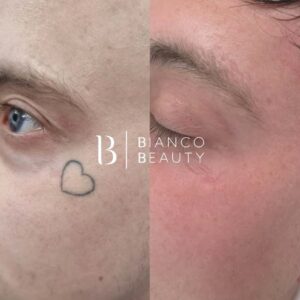 Picosecond technology for cosmetic tattoo removal treatment