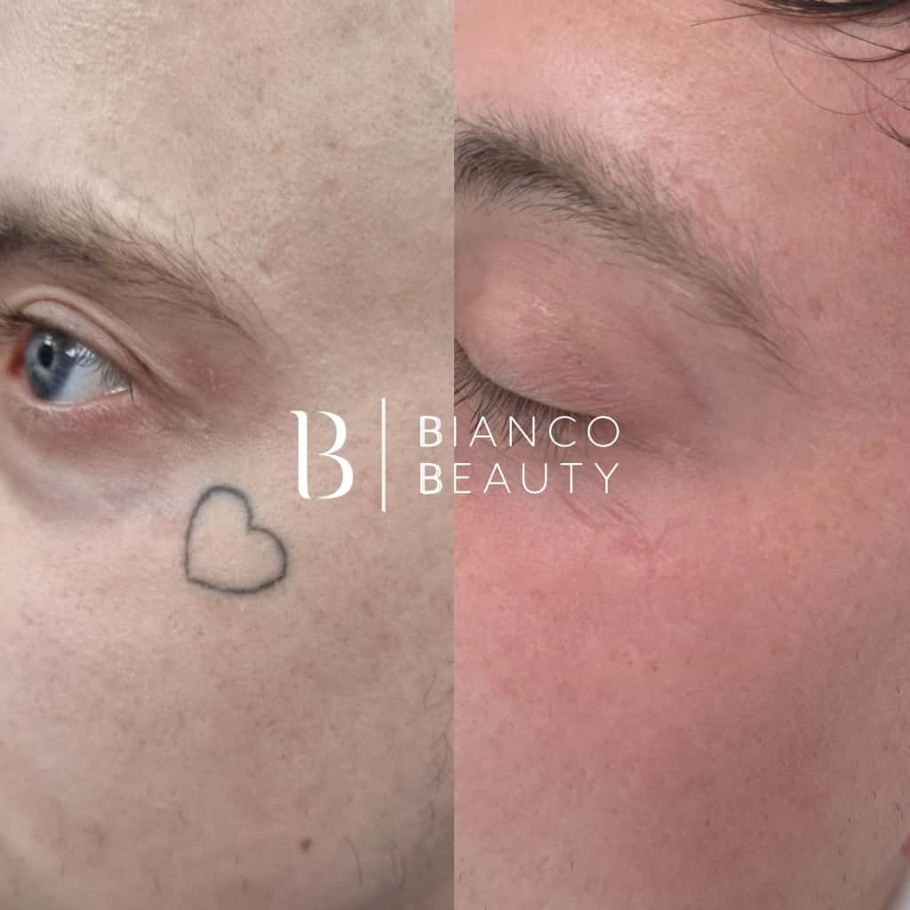 Picosecond technology for cosmetic tattoo removal treatment