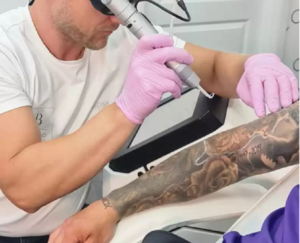 How many sessions of laser tattoo removal you need