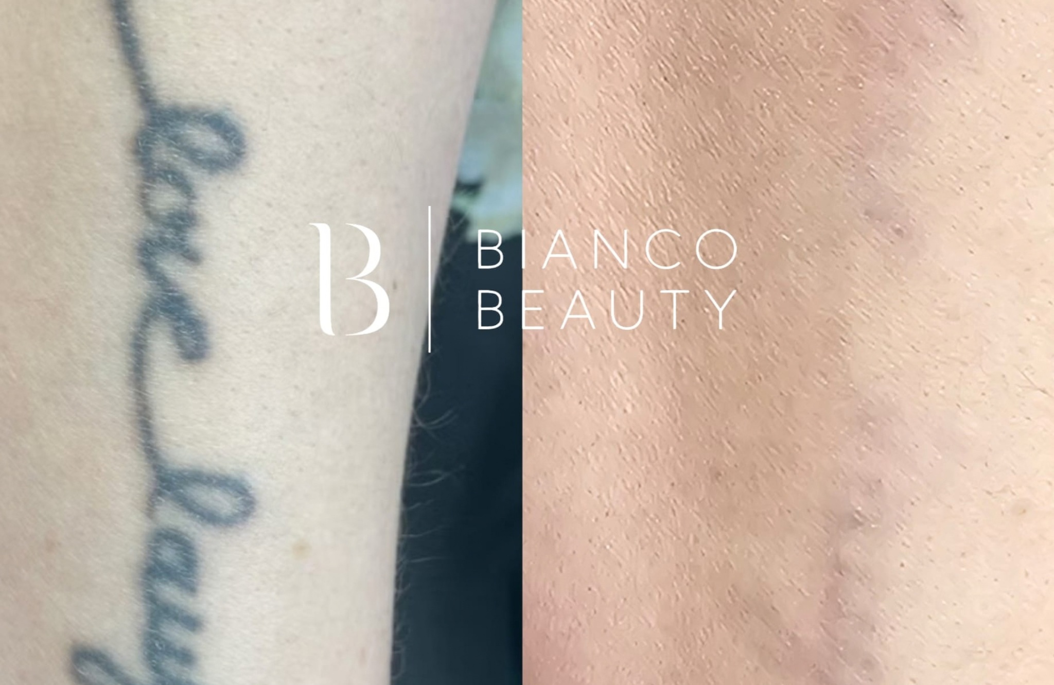 Alcohol after tattoo removal before and after laser tattoo removal treatment
