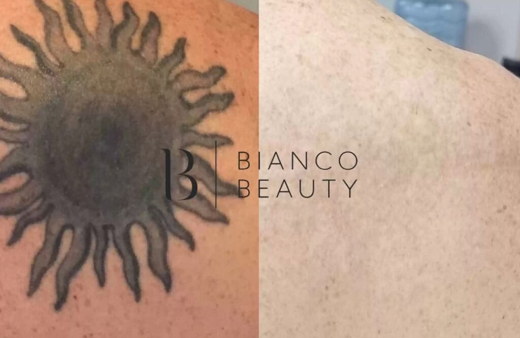 Can a tattoo be completely removed with laser tattoo removal treatment
