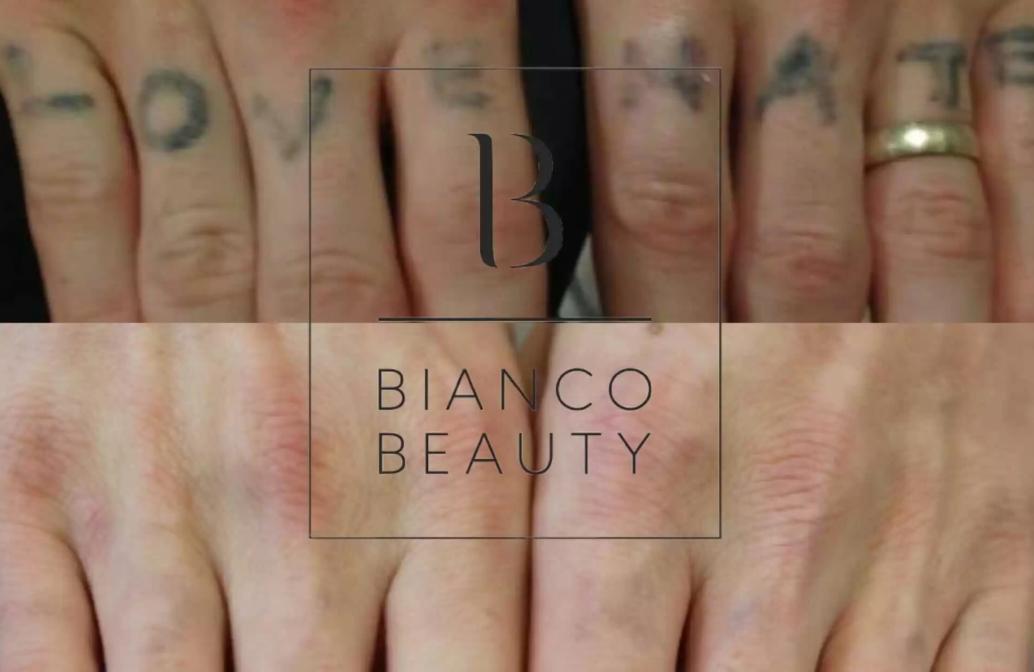 Getting a new tattoo after laser tattoo removal