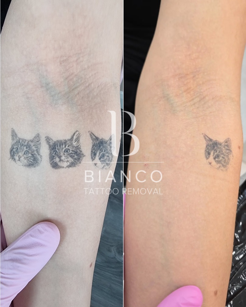 Multiple Tattoo Removal