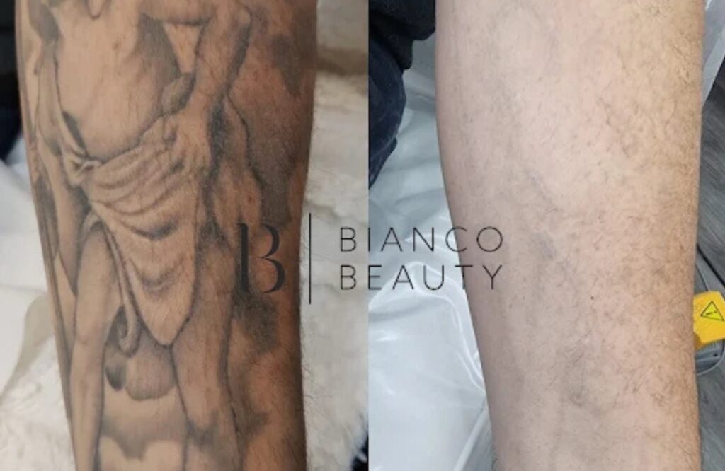 Tattoo removal cost UK guide with before and after results