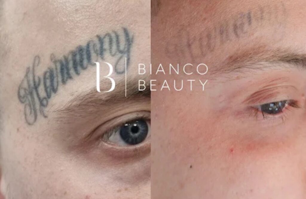 facial tattoo removal before and after results