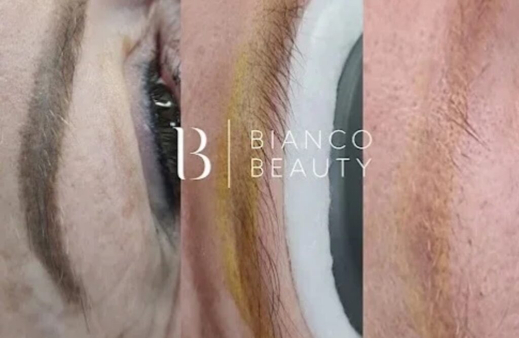 Eyebrow tattoo removal colour changes revealing red orange and yellow pigments