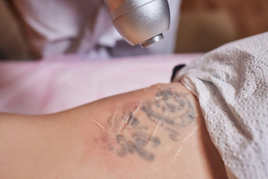 Hyperpigmentation after laser tattoo removal