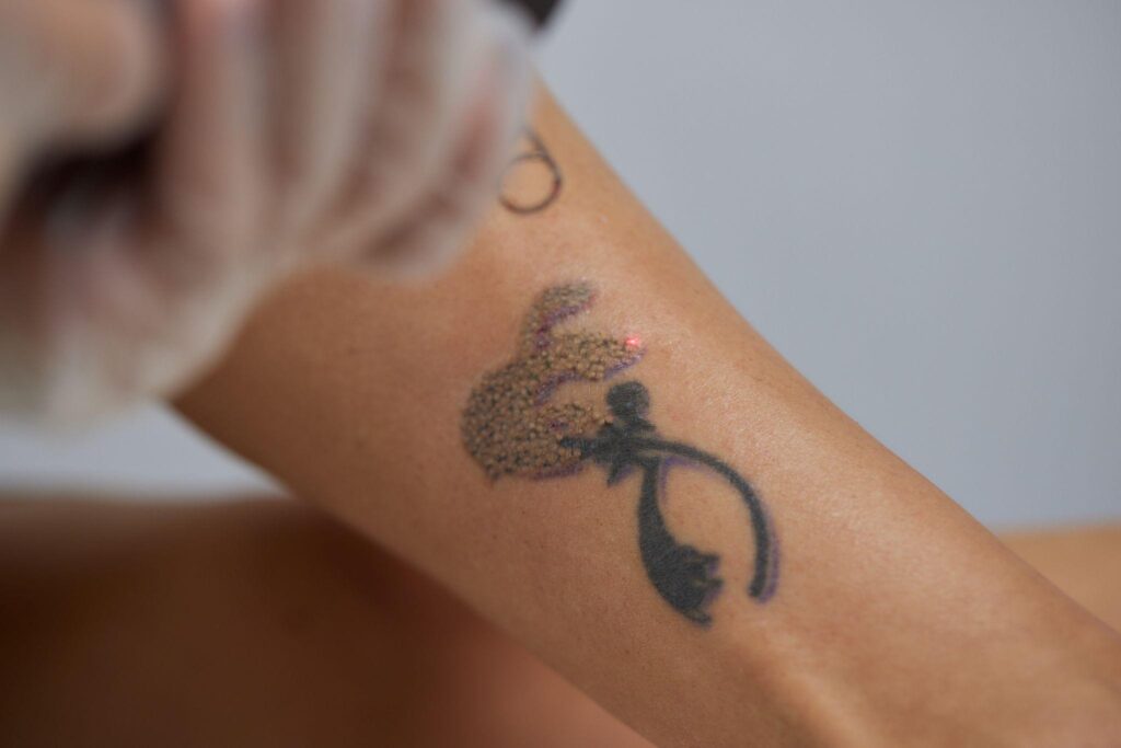 partial tattoo removal